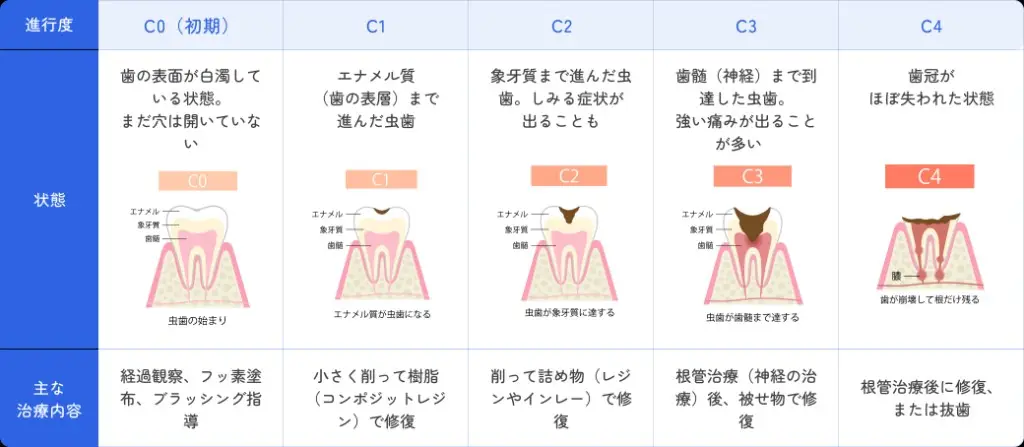 虫歯の進行度（C0〜C4）の進行段階・状態・主な治療内容を示した図表