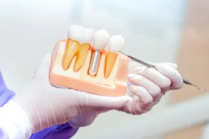 歯科模型でインプラントの構造を説明している様子