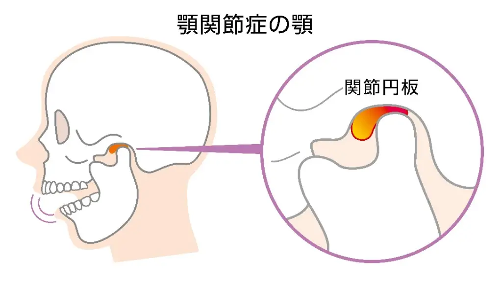 顎関節と関節円板の位置関係を示したイラスト